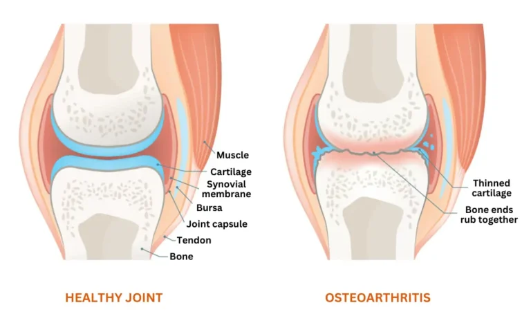 Ayurvedic treatment for Osteoarthritis 1 Ayurveda Treatment for Osteoarthritis at UWAY