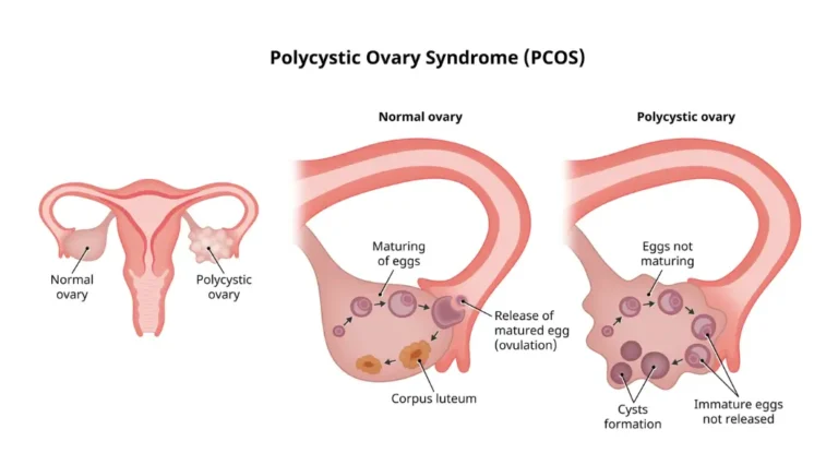 Ayurvedic treatment for PCOS 1 Ayurvedic treatment for PCOS