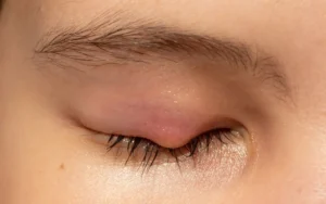 ayurveda treatment for abscess management