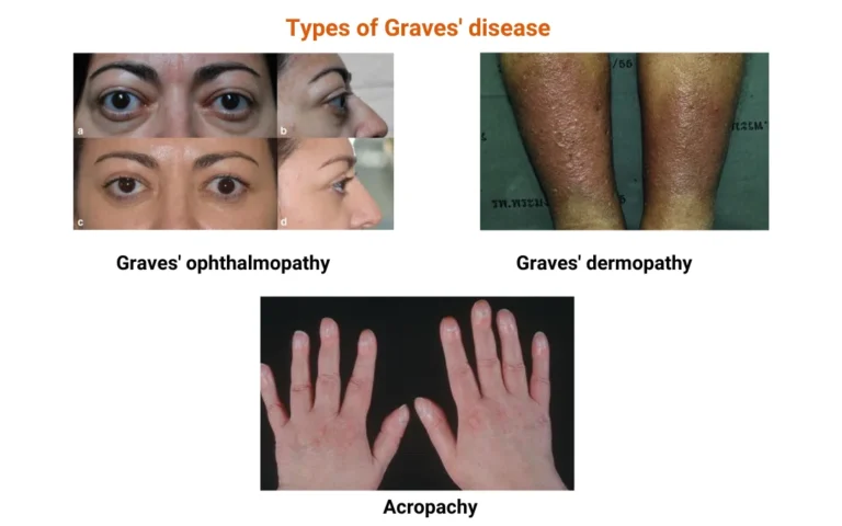 ayurveda treatment for graves' diseases