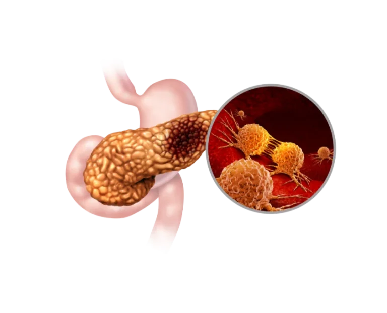 Ayurveda treatment for Pancreatitis