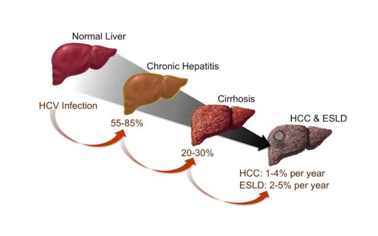 Symptoms of Hepatitis