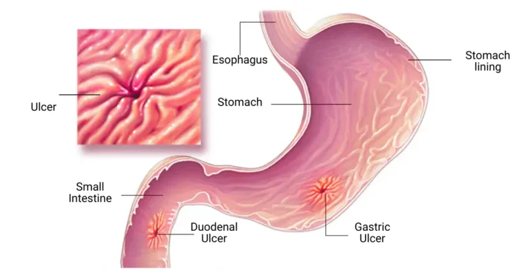 ayurvedic treatment for stomach ulcer
