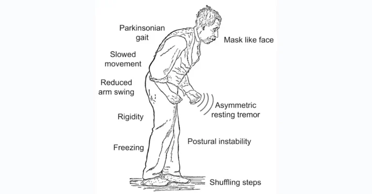 Parkinsons Disease Treatment: A Holistic Approach with Ayurveda