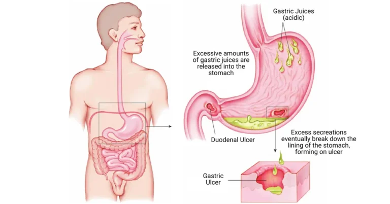 Ayurvedic treatment for peptic ulcer
