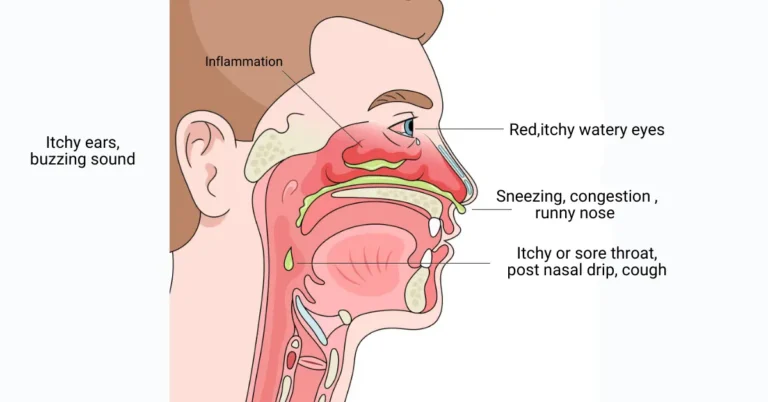 how to treat rhinitis Ayurvedic remedies for rhinitis allergic rhinitis treatment Ayurvedic treatment for nasal allergy chronic nasal congestion relief natural rhinitis treatment rhinitis symptoms and cure Ayurveda for rhinitis relief Pratishyaya Ayurvedic treatment