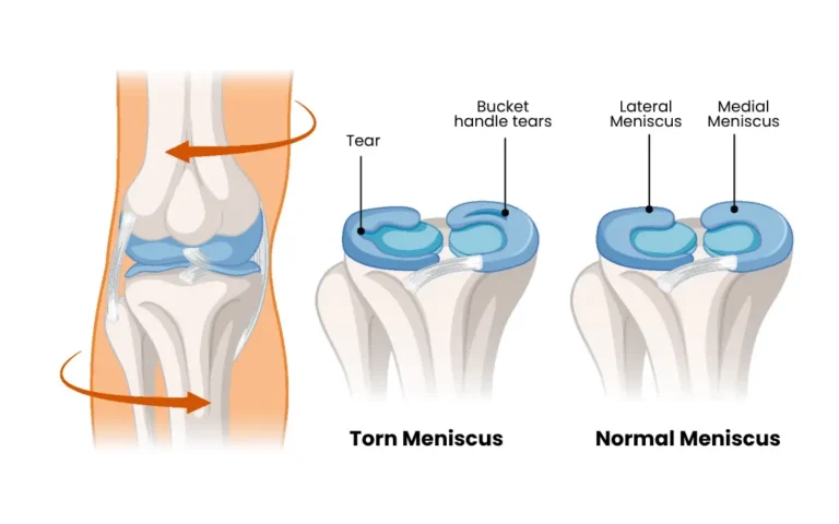 Why So Many Meniscus Injuries End Up at Our Ayurveda Clinic — And What We Do Differently