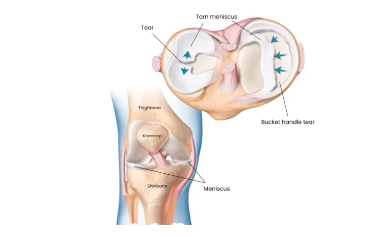 Why So Many Meniscus Injuries End Up at Our Ayurveda Clinic — And What We Do Differently